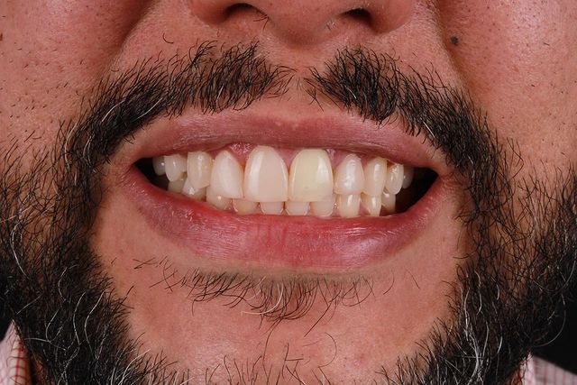 Antes diseño dental